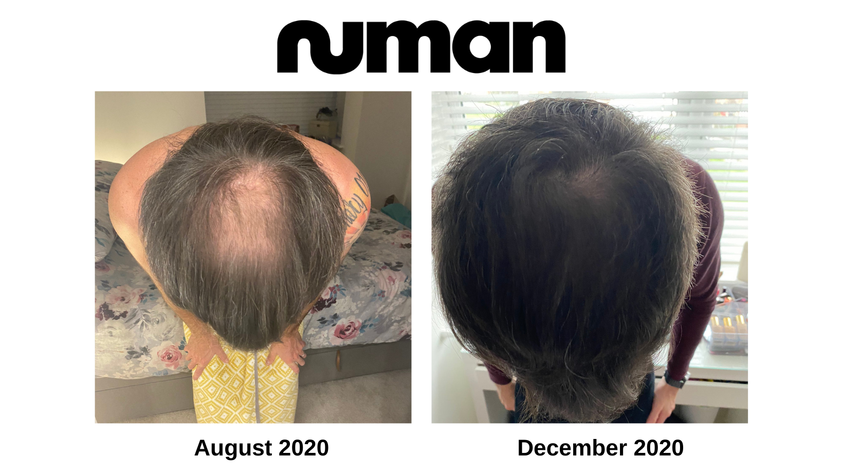 numan hair regrowth